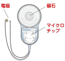 人工内耳体外部イメージ